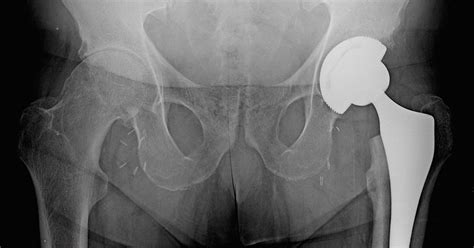 hip surgery greenwich|Total Hip Replacement .